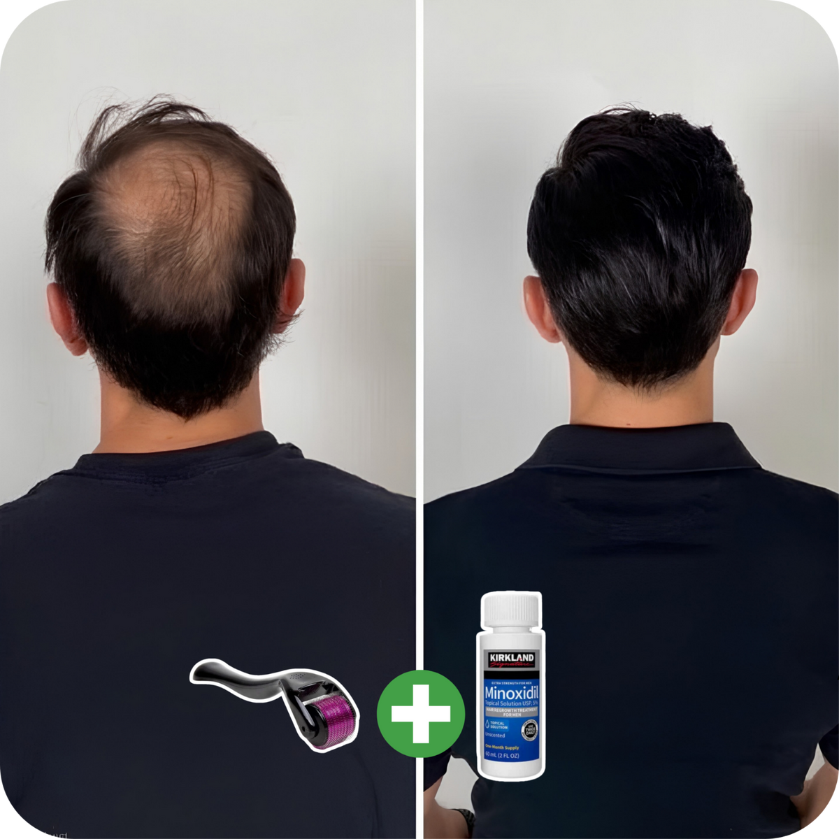 Tratamiento completo para Barba y Cabello + Derma Roller de Regalo | MinoxiMen