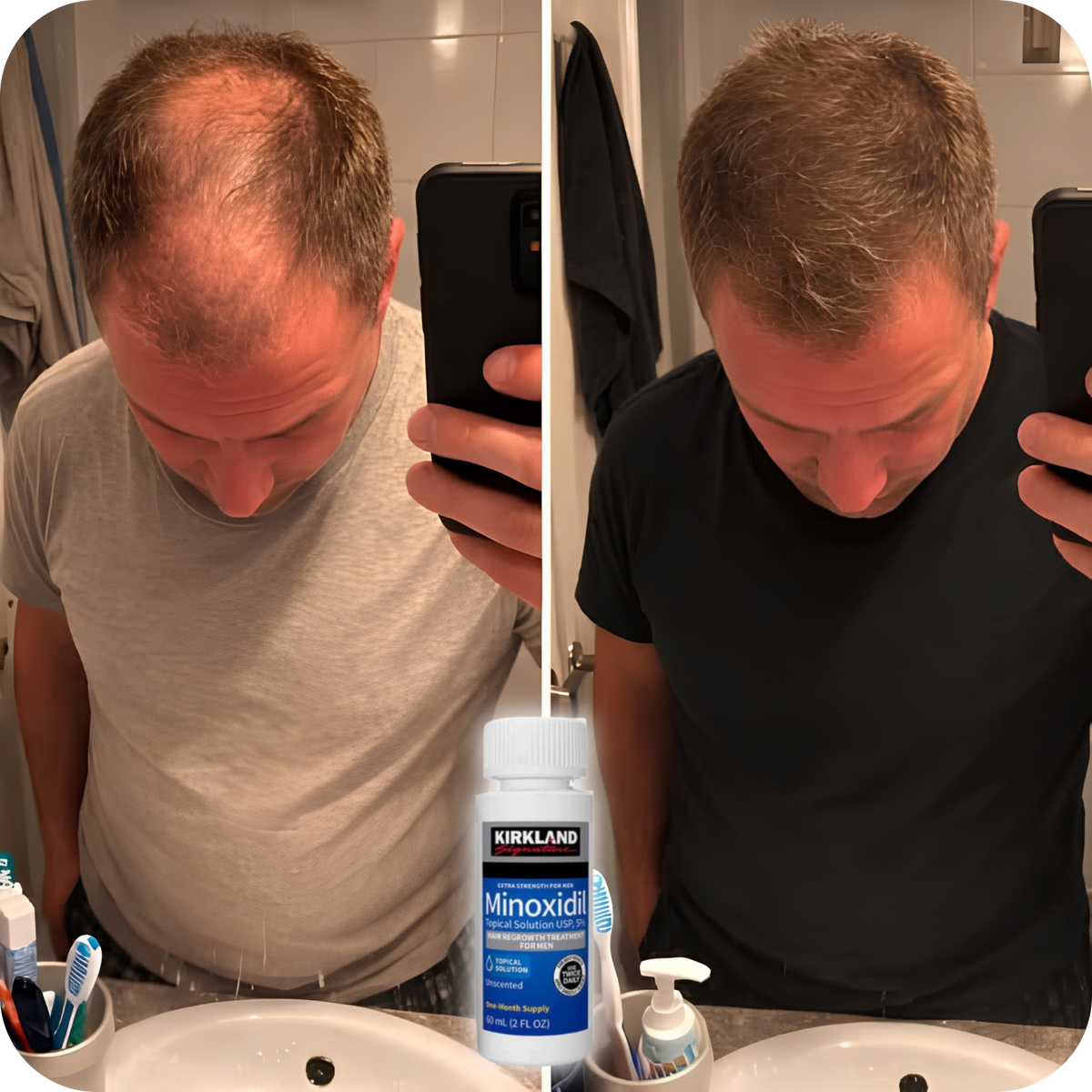 Minoxidil Kirkland Signature