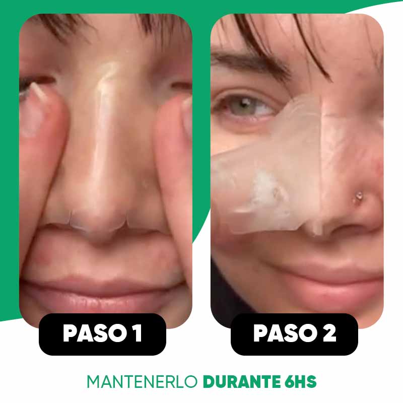 Pack de 10 Parches Anti-Acné para Nariz | Luminex