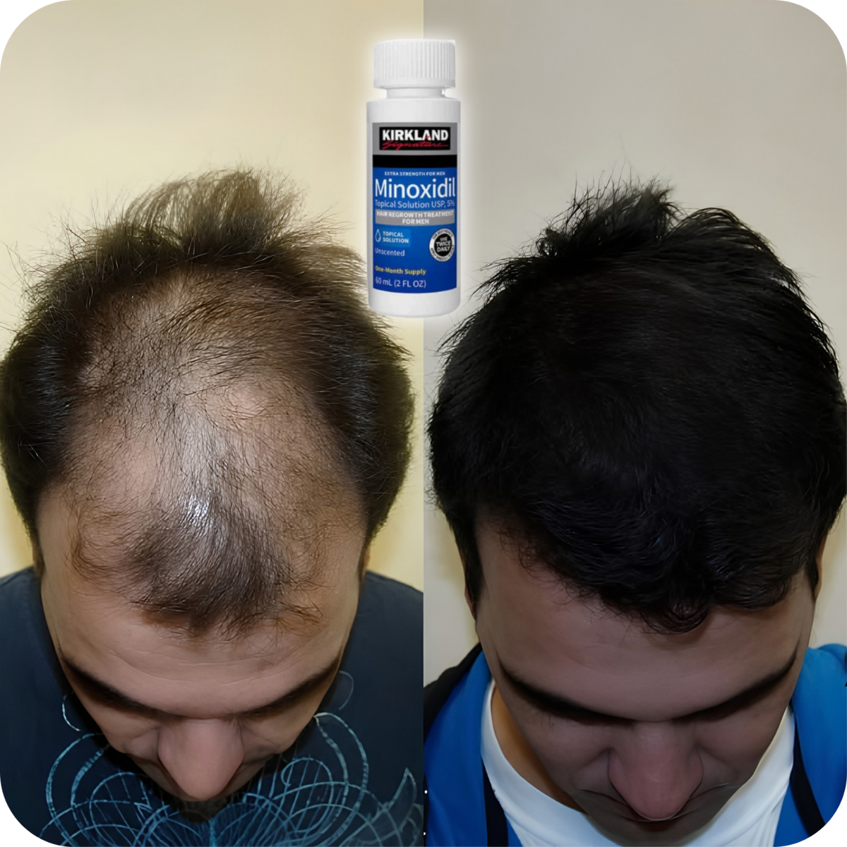 Minoxidil Kirkland Signature